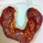 Gross Out The Gross Room Winners - #2 Horseshoe Kidney Screen Shot 2023-03-20 at 12.55.56 PM