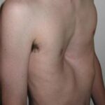 Gross Out The Gross Room Winners - #3 Pectus Excavatum thoracic_pectus
