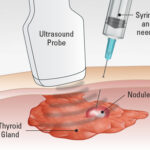 Simple Blood Tests to Screen for Cancer?? TCC_Fine_Needle_Aspiration_Biopsy-1
