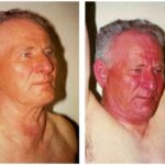 Mystery Diagnosis: SVCS, Pemberton's Sign! photo-pembertons-physicalexam-clinical-sign-original